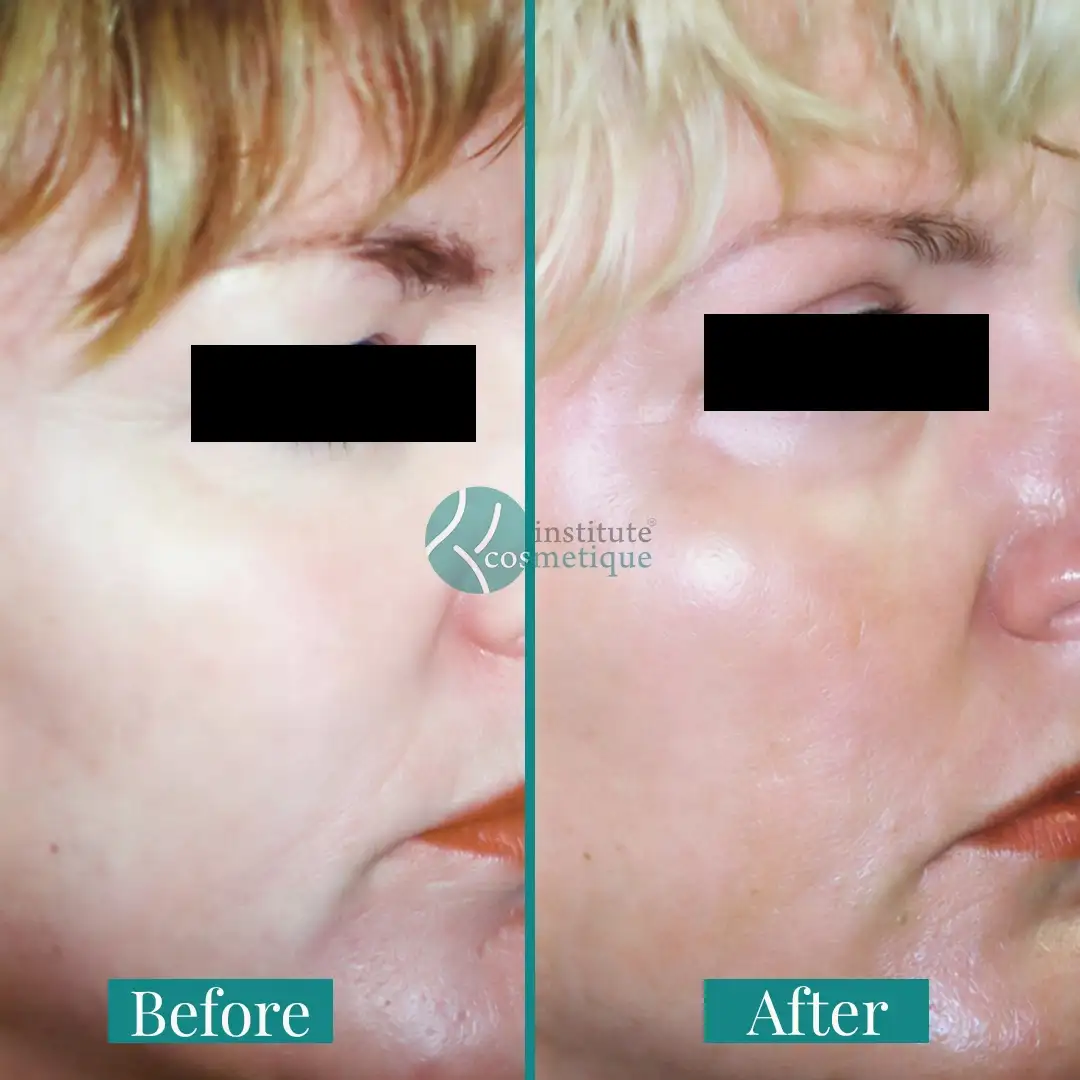 upper-lower-eyelid-lift-results