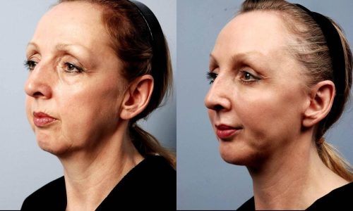 image7_surgical_facial-fat-transfer